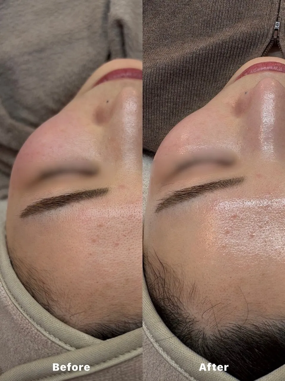 ダクトピール◎肌の内部再生♪