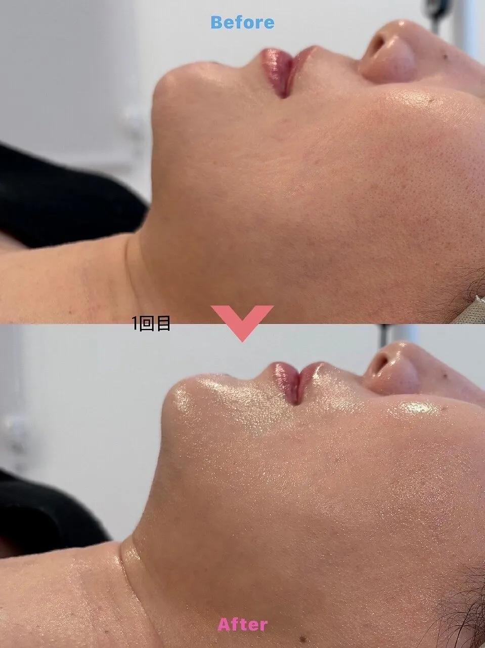 美肌REDショットプレミアム♪