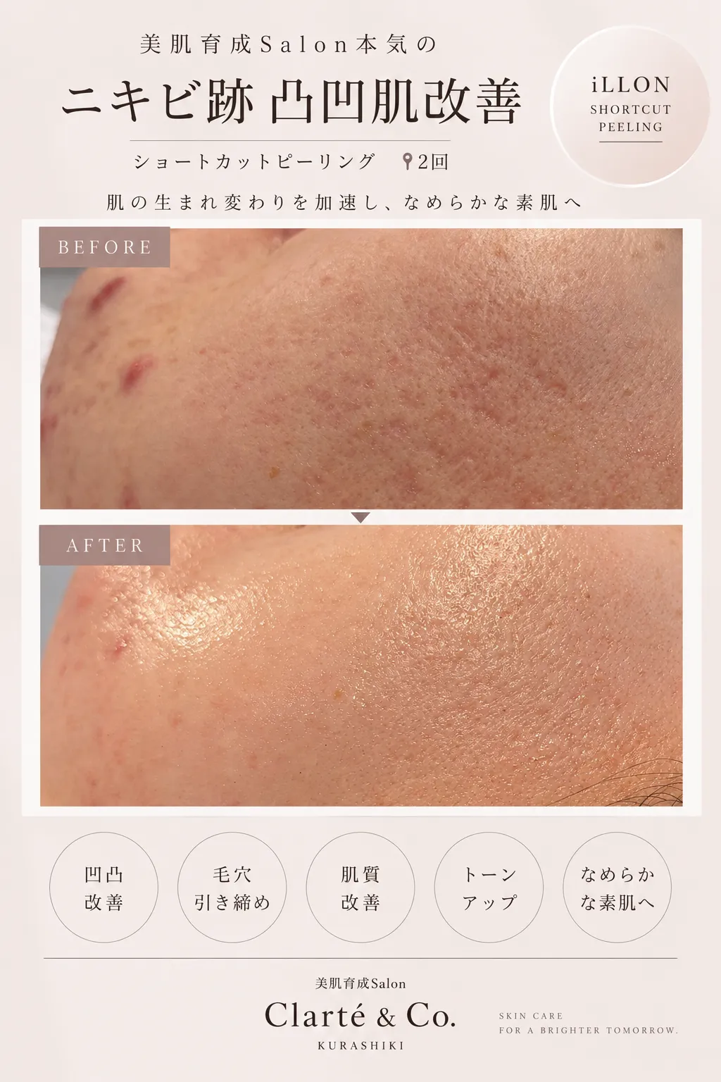 韓国肌管理や肌育で目指す美肌と水光肌のためのクレーターやニキビ跡肌質改善入門